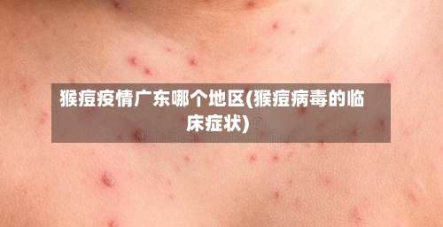 猴痘疫情广东哪个地区(猴痘病毒的临床症状)-第3张图片